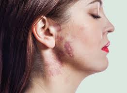 Birthmarks Removal Treatment Abu Dhabi